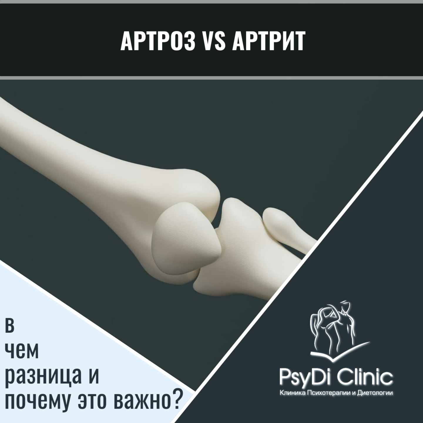 Артроз vs артрит: в чем разница и почему это важно?