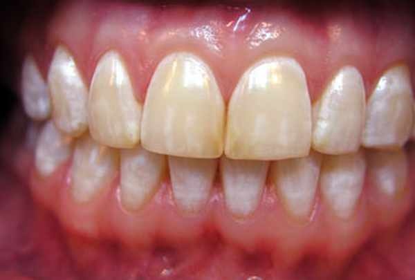 Флюороз зубов у детей: Лечение и профилактика