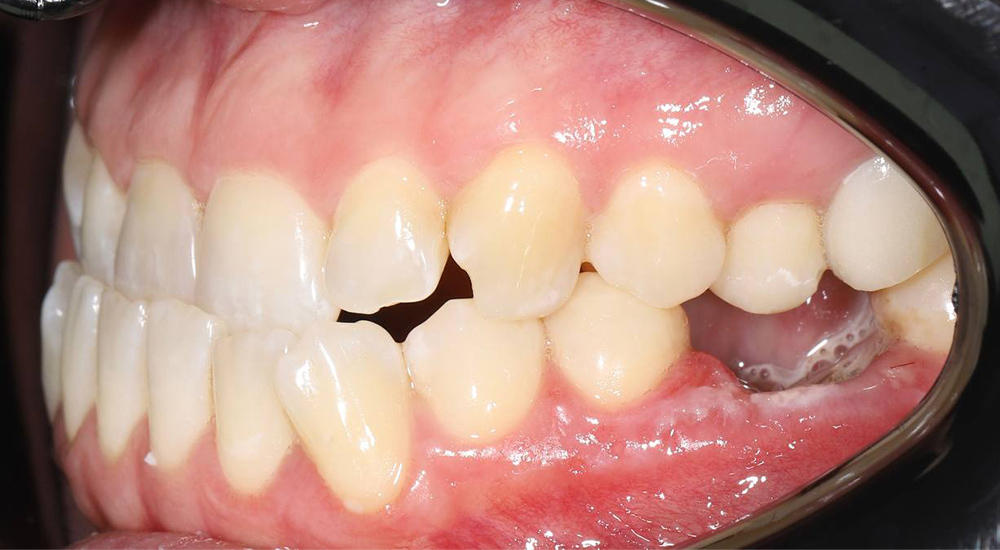 Комплексная реабилитация при скелетных и зубных нарушениях с использованием элайнеров и имплантации