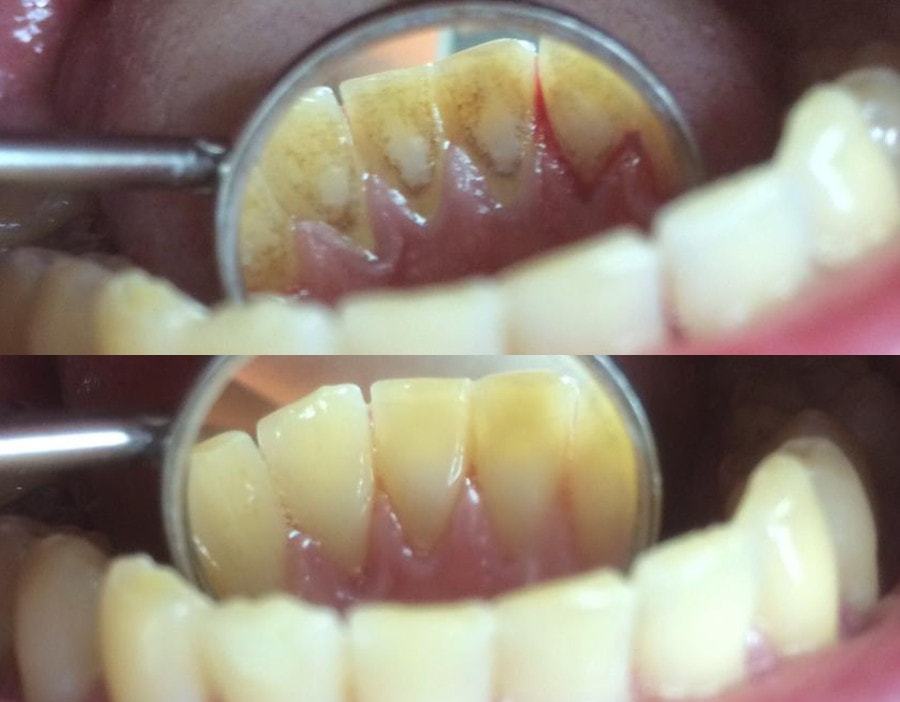 Профессиональная чистка полости рта: фото до и после
