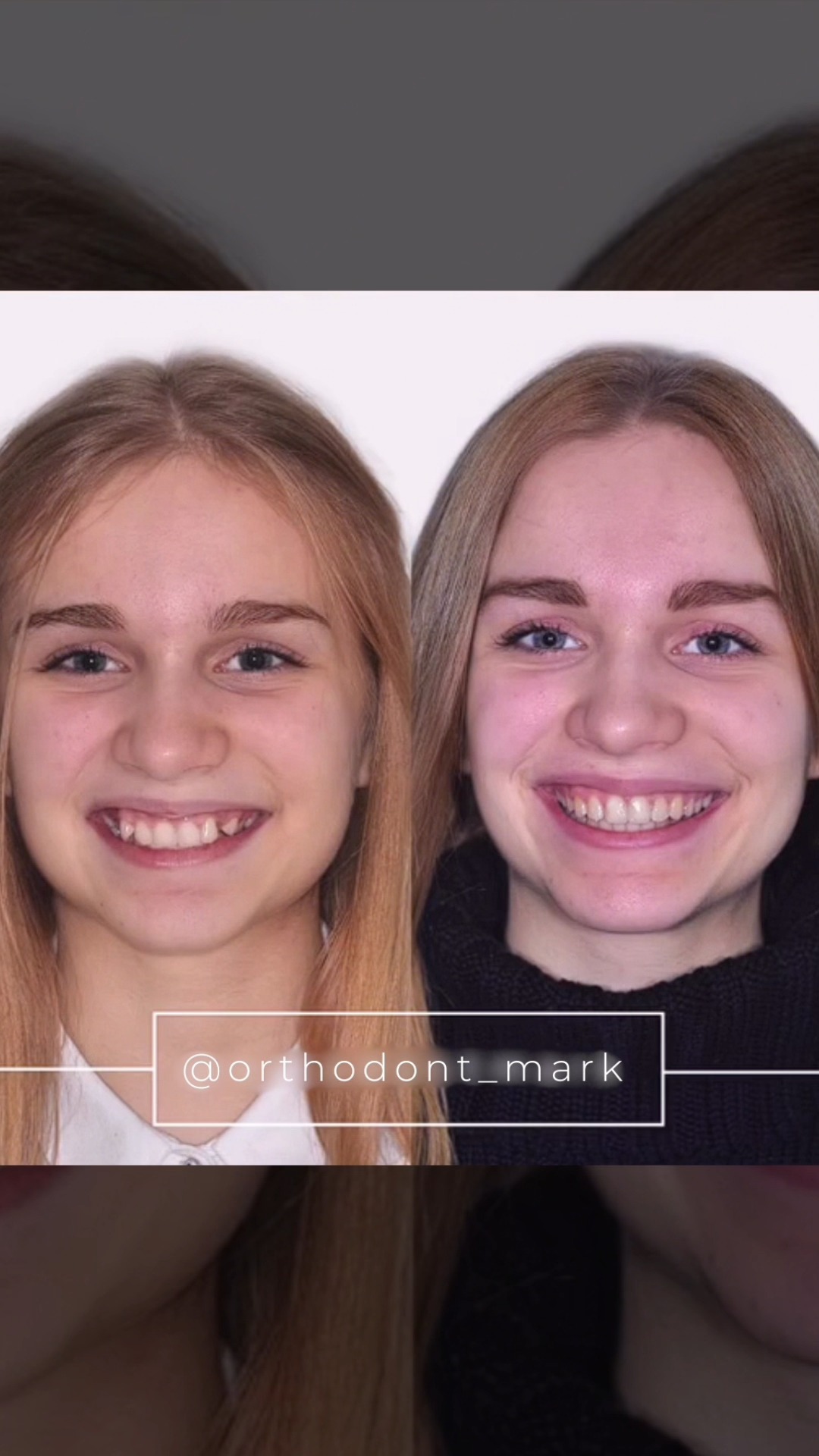 Correcting Deep Bite, Cheek Corridors, and Smile Asymmetry