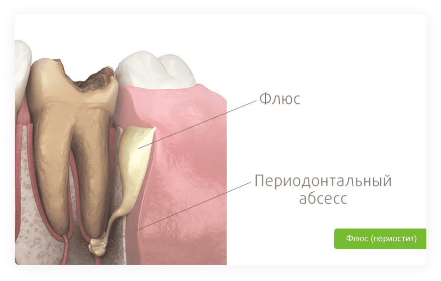 Киста под коронкой, болит зуб. Что делать? - Статьи