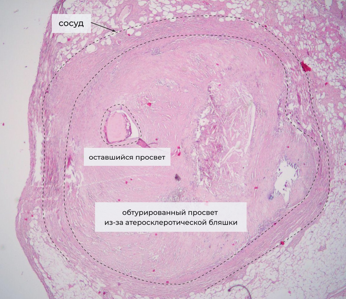 Просвет сосудов. Тромбоз коронарной артерии микропрепарат. Атеросклеротическая бляшка микро. Обтурирующий тромб патанатомия микропрепарат. Атеросклероз венечной артерии с тромбом микропрепарат.
