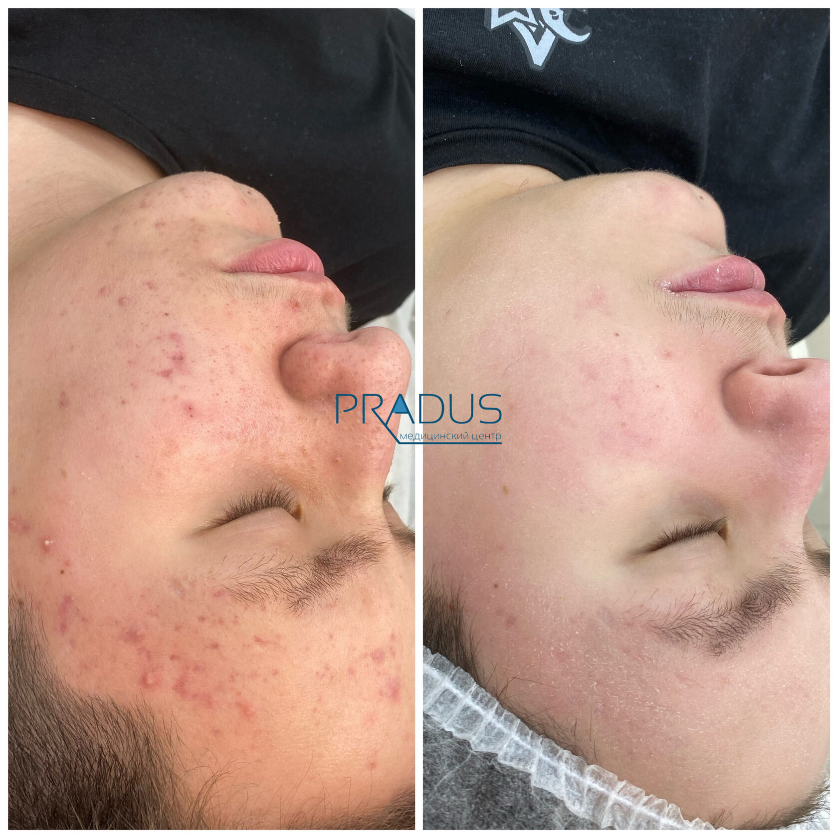 Лечение акне у женщины в клинике PradusCOSMO, СПб. До и после процедуры