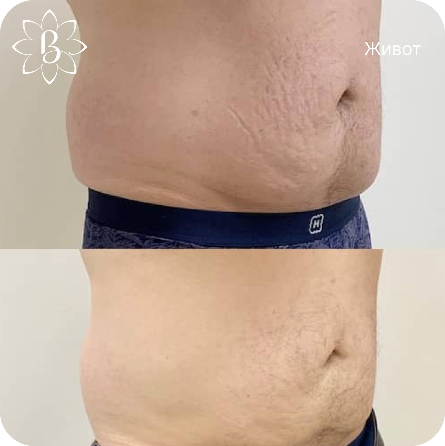 Диодная лазерная эпиляция