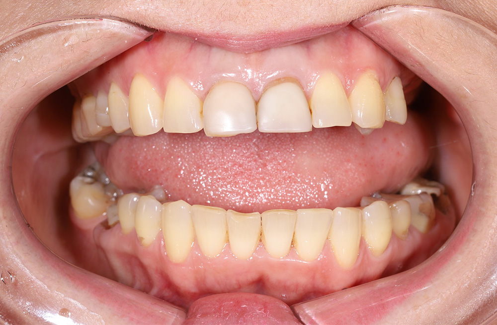 Имплантация зубов с последующим протезированием на имплантах