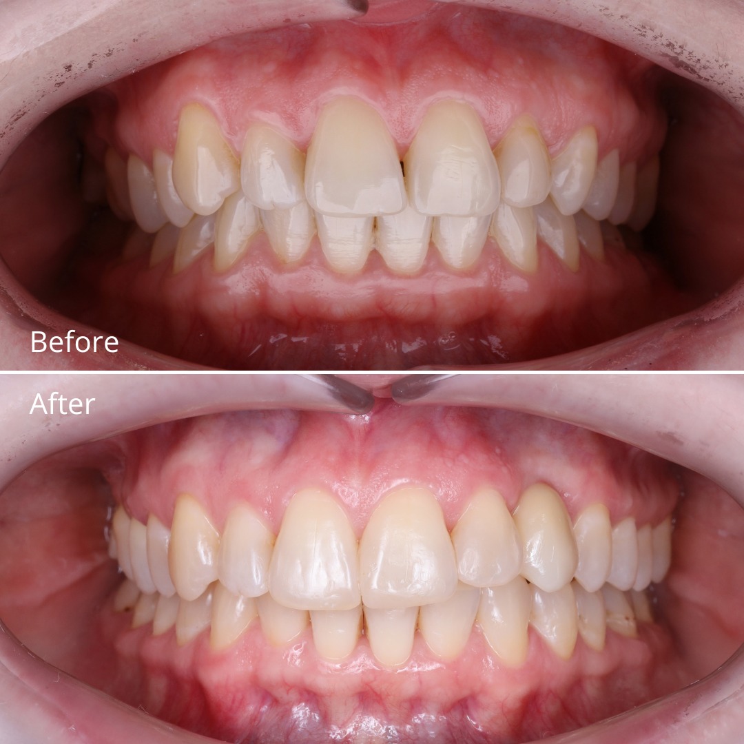 Stage photo showing canine space recreation during Invisalign treatment — photo 2 of 3