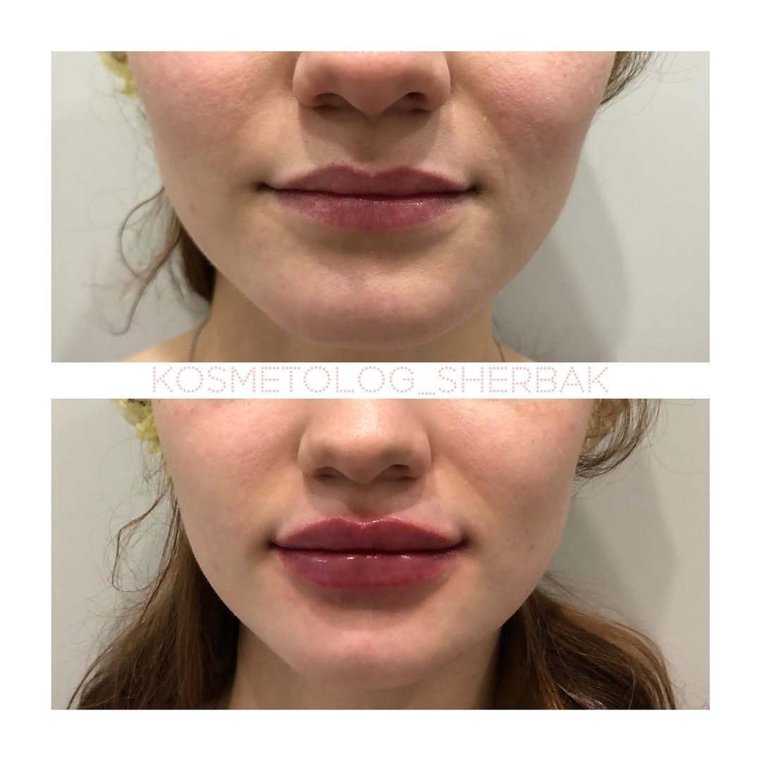 До и после контурной пластики губ. Увеличение объёма без утяжеления. PradusCOSMO, Васильевский остров