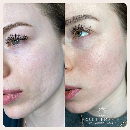 удаление постакне в москве таганский район