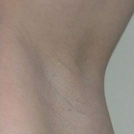 после лазерной эпиляции под мышками