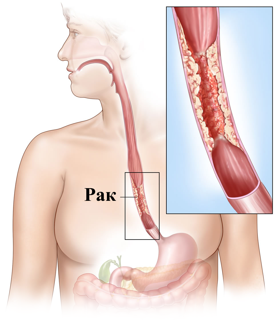 Рак пищевода симптомы и проявления у женщин. Постваготомический рефлюкс эзофагит. Десквамативный эзофагит. Геморрагический эзофагит.