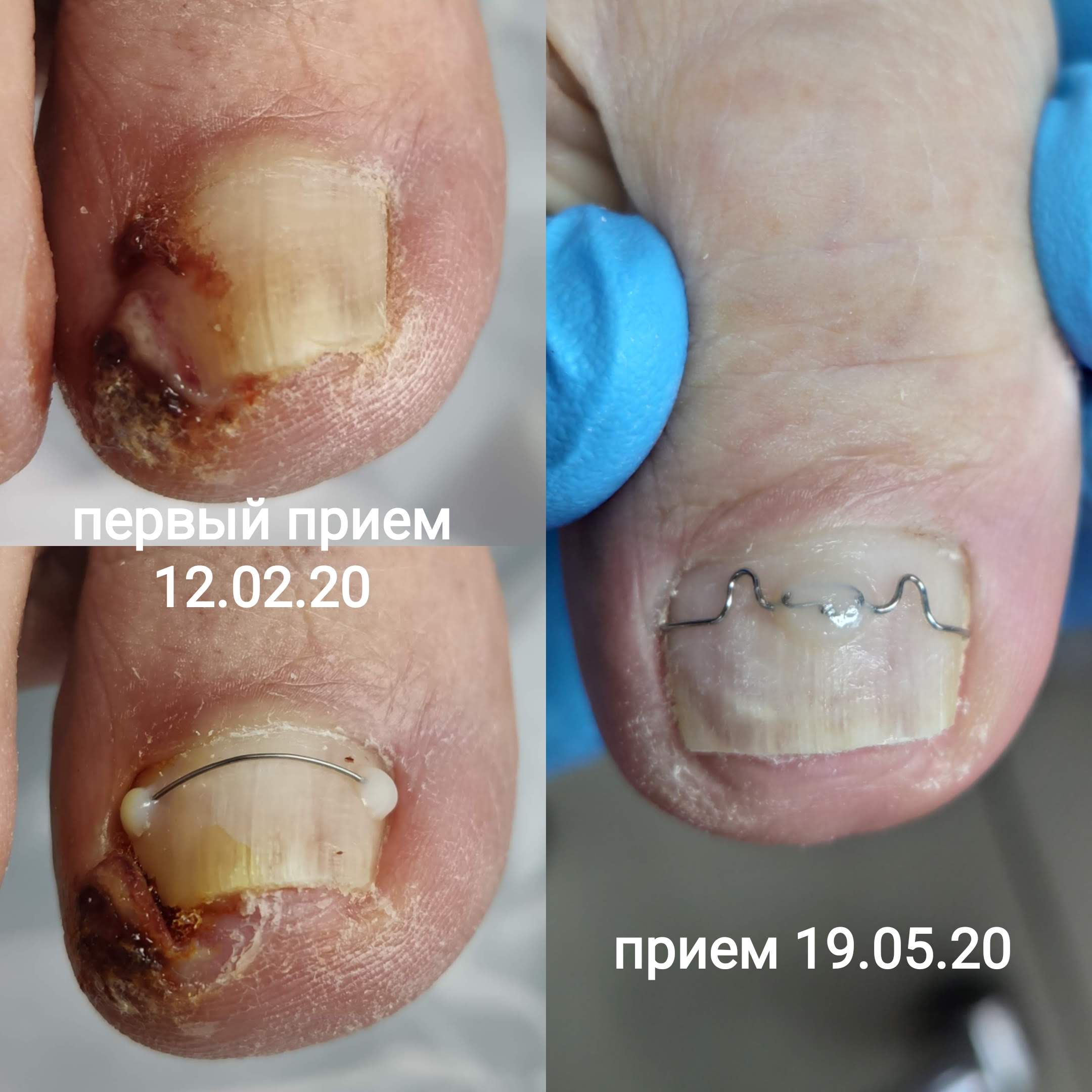 Лечение и удаление вросшего ногтя в Перми без боли по доступной цене ...