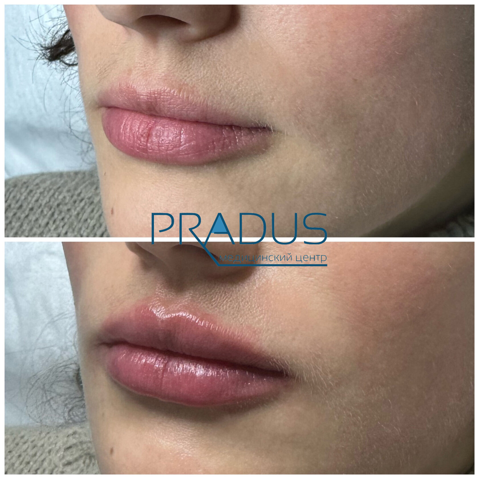 До и после контурной пластики губ. Увеличение объёма без утяжеления. PradusCOSMO, Васильевский остров