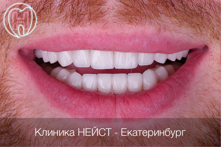 мужские керамические виниры в Екатеринбурге цвет Блич 2 (Bleach2)