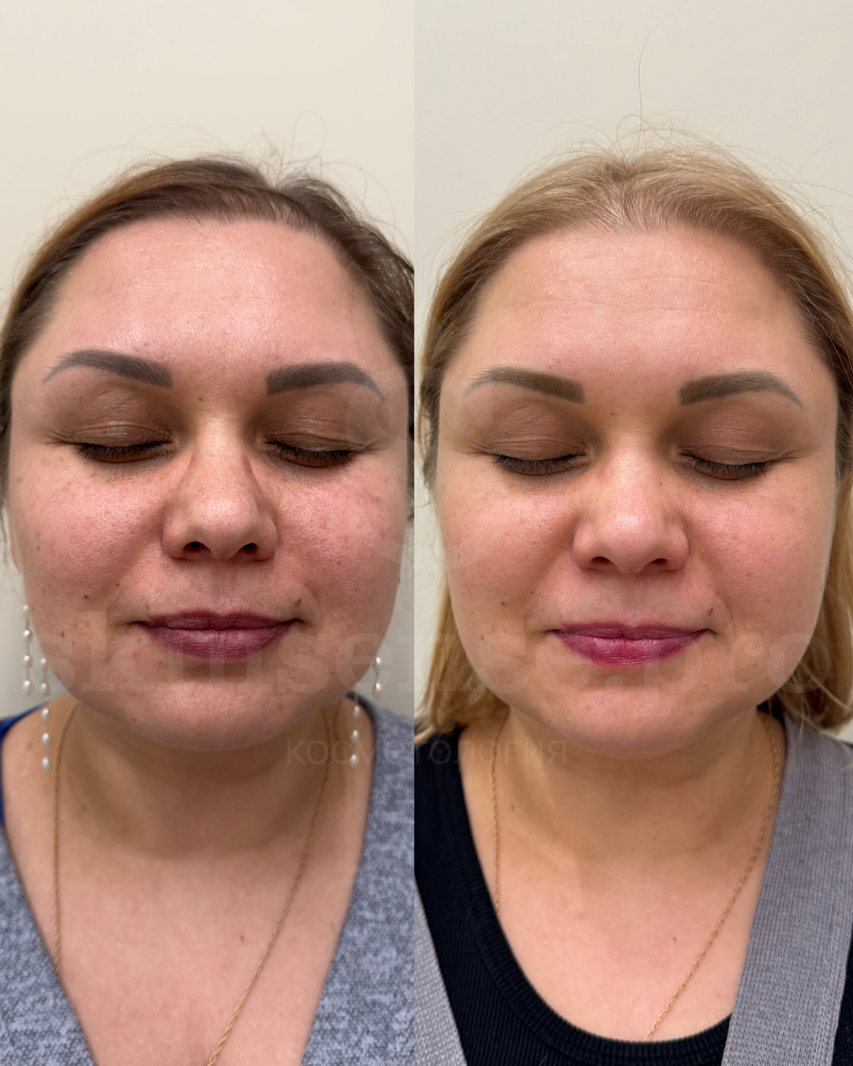 2 миндальных пилинга + биоревитализация  Врач Явкун Виктория.