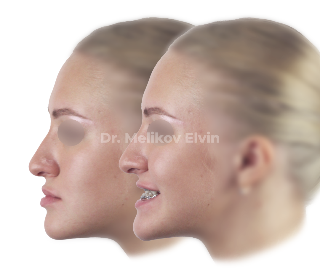 Мезиальный прикус