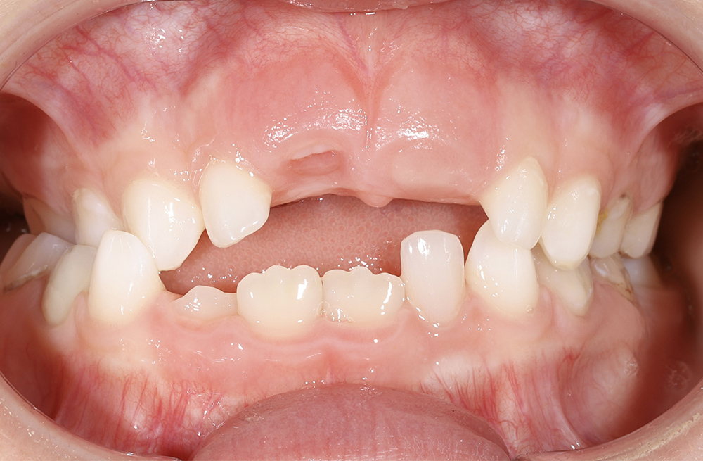 Два этапа ортодонтического лечения у семилетней пациенткиот сложного нарушения прикуса до коррекции положения языка