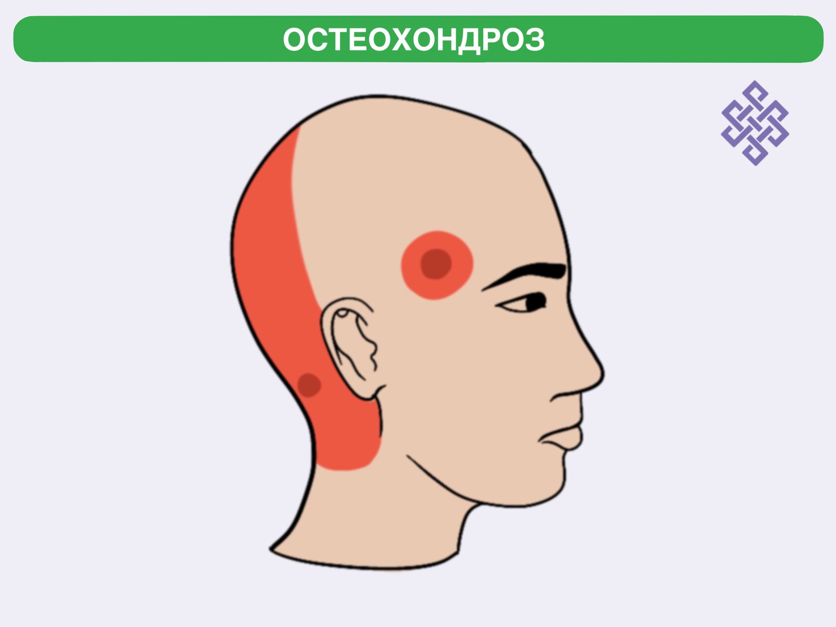 Виды головных болей: при наклоне головы, в области затылка, в висках, при давлении.