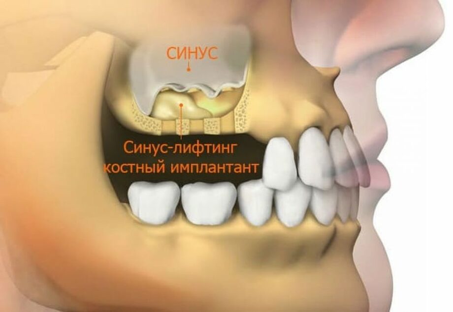 Синус лифтинг в стоматологии фото