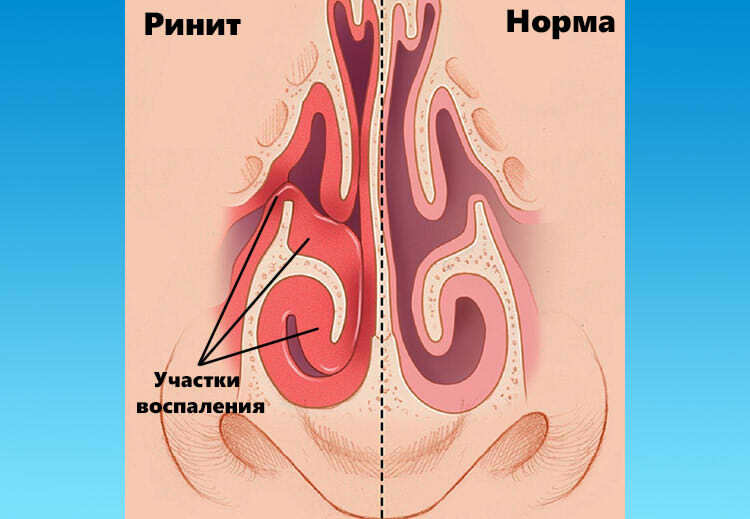 Хронический вазомоторный ринит: причины, симптомы и лечение вазомоторного ринита