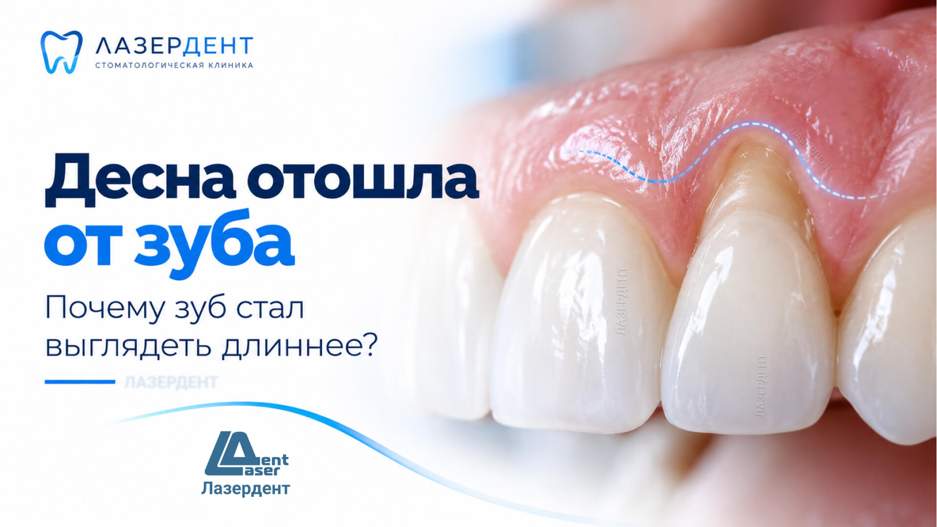 Десна отходит от зуба и оголяется корень — рецессия десны, причины и лечение в стоматологии «Лазердент» Хабаровск