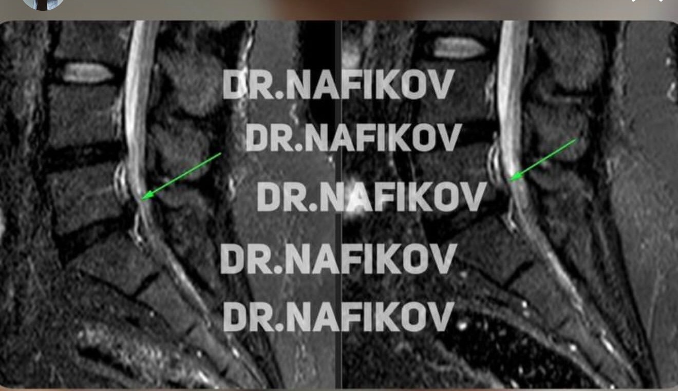 МРТ до и после лечения, Пациент Д., 33 года