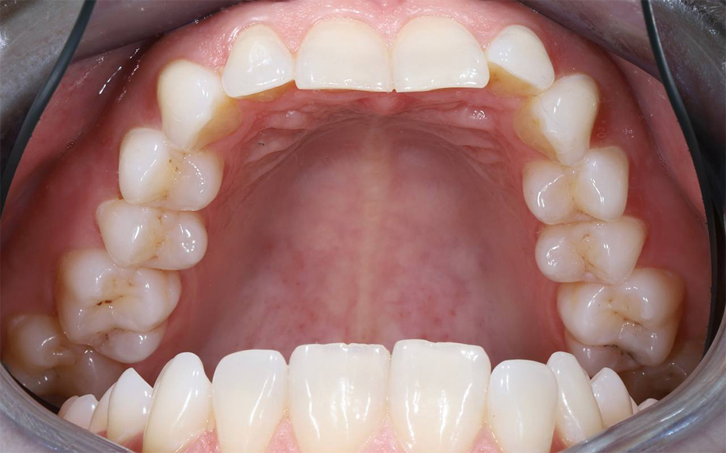 Ортодонтическое лечение на керамической брекет-системе