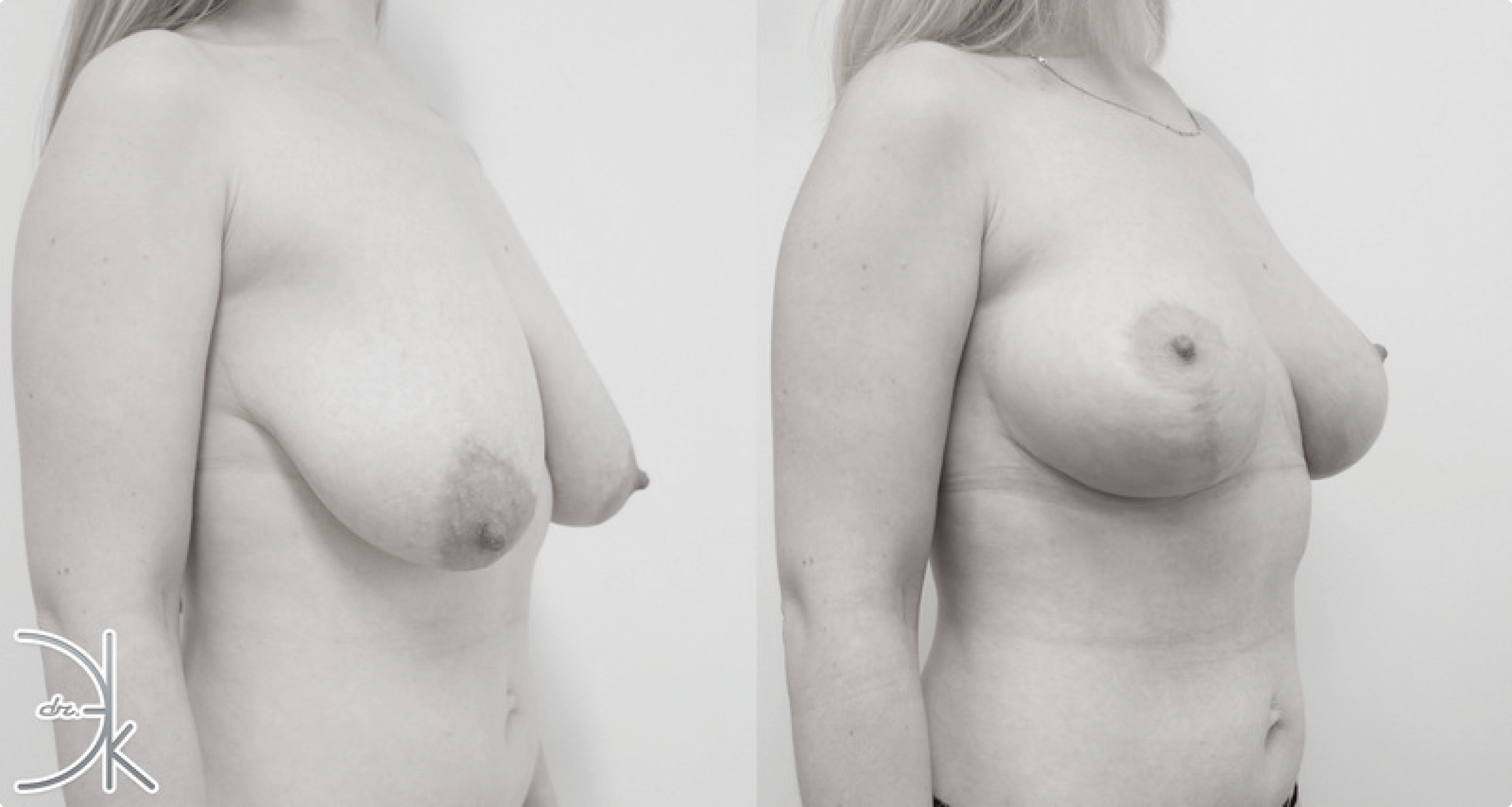 липосакции груди у женщин фото 14