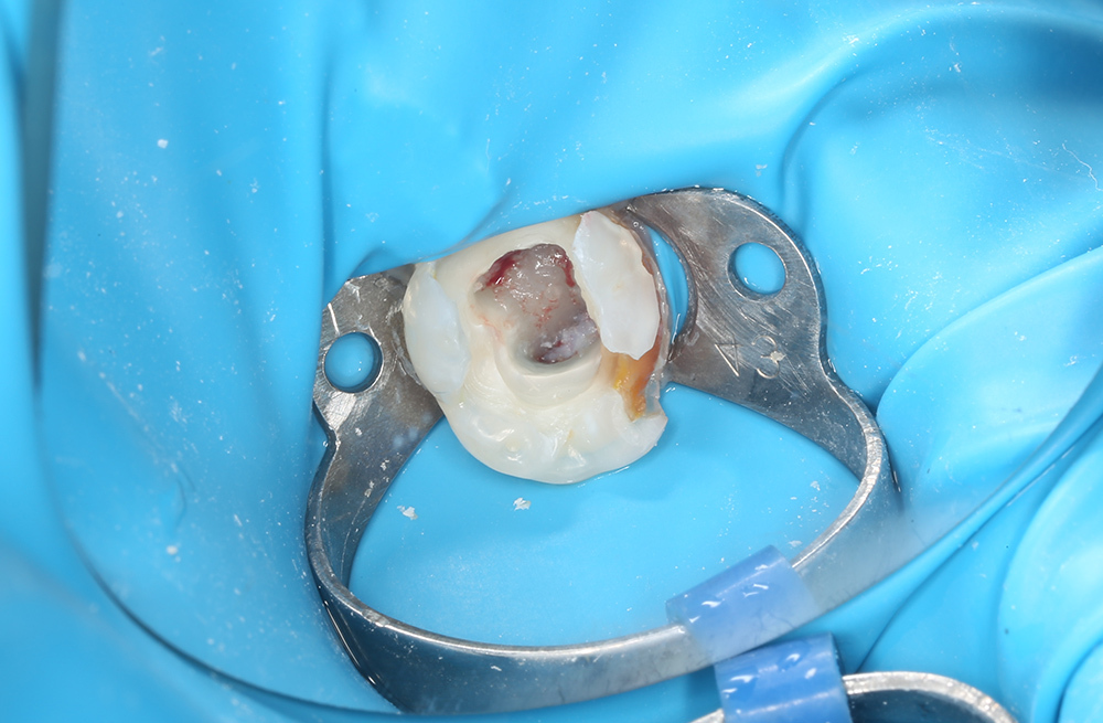 Как мы сохранили молочный зуб коронкой после лечения сложного пульпита у ребёнка под ЗАКС