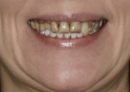 Установка и замена виниров в стоматологической клинике Пробел