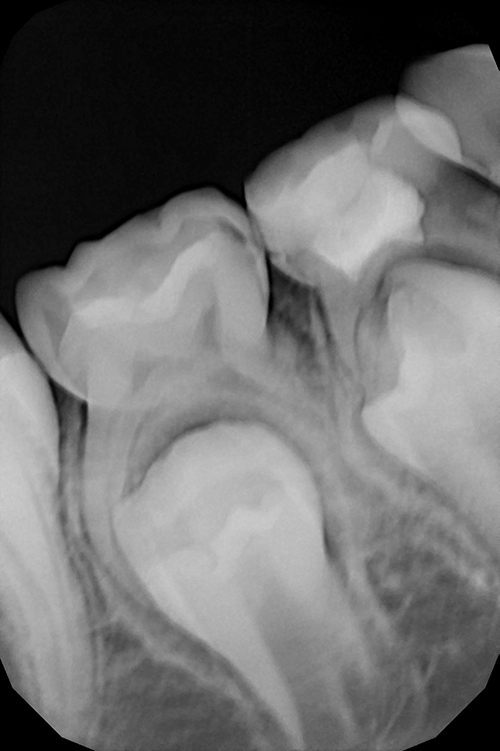 Установка пломбы при кариесе жевательного зуба у ребёнка
