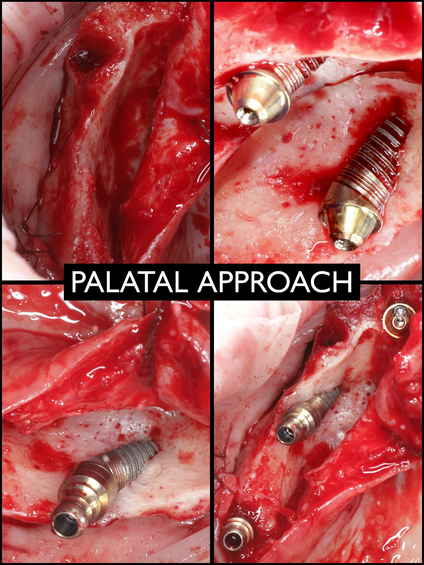 Palatal approach при атрофии верхней челюсти