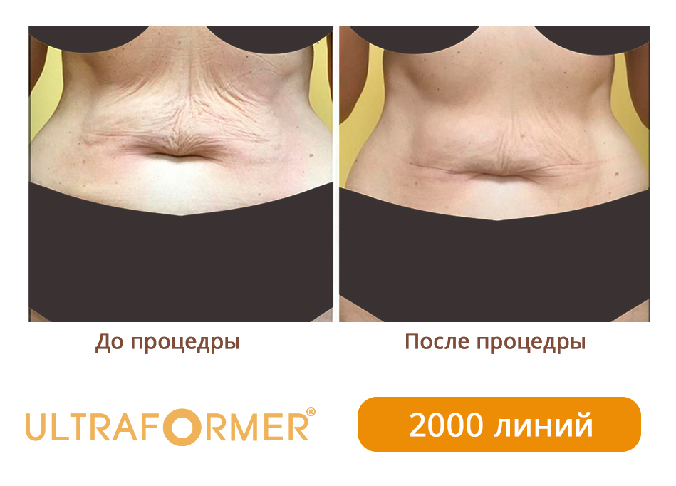 Ультраформер отзывы до и после