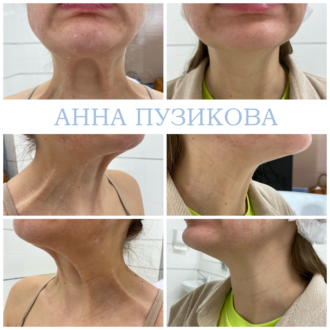 Результат ботулинотерапии — коррекция мимических морщин на лбу и в области глаз. Косметолог Пузикова Анна Анатольевна, Санкт-Петербург