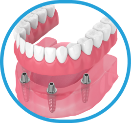Установка имплантов в Дербенте. Имплантация при отсутствии одного зуба.
