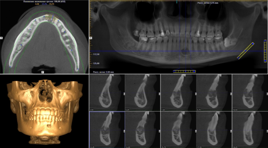 Кт верхней и нижней челюсти фото