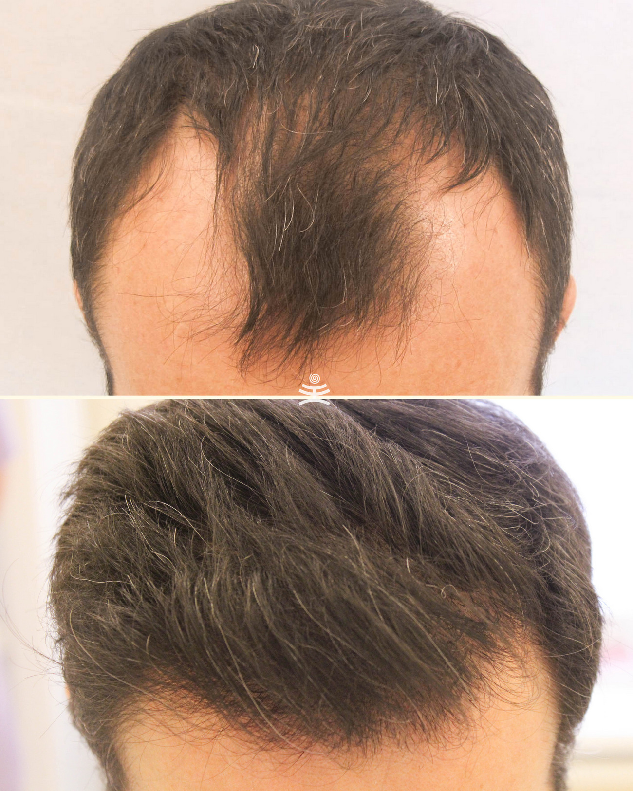 Откуда берут волосы для пересадки. Мужская трансплантация волос. Откуда берут волосы для пересадки. Откуда берут волосы для пересадки. Трансплантация волос fue.