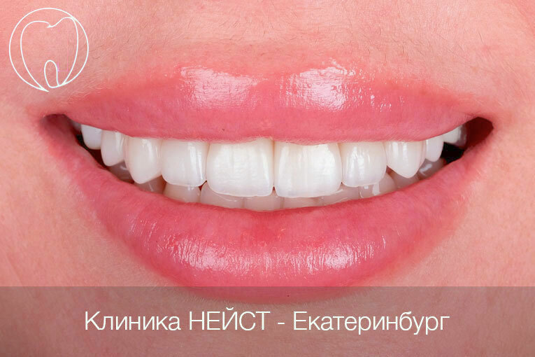 натуральные керамические виниры Премиум Екатеринбург цвет Блич 4, А1 (Bleach 4 A1)