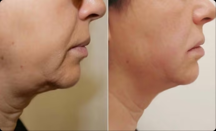 Ультраформер отзывы фото до и после