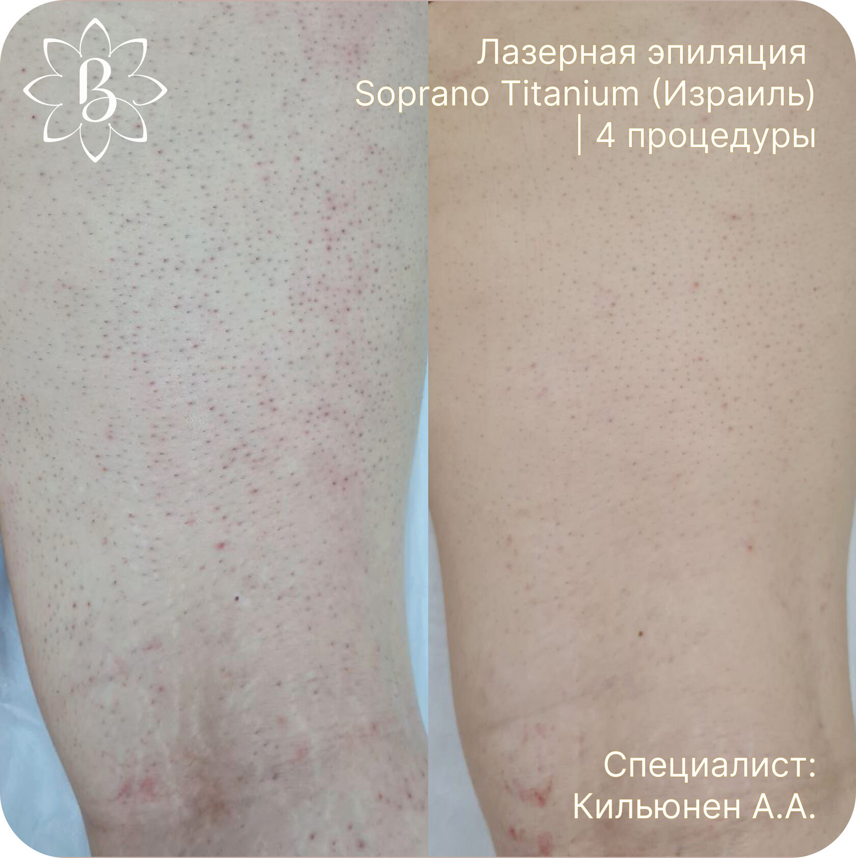 Лазерная эпиляция СПб