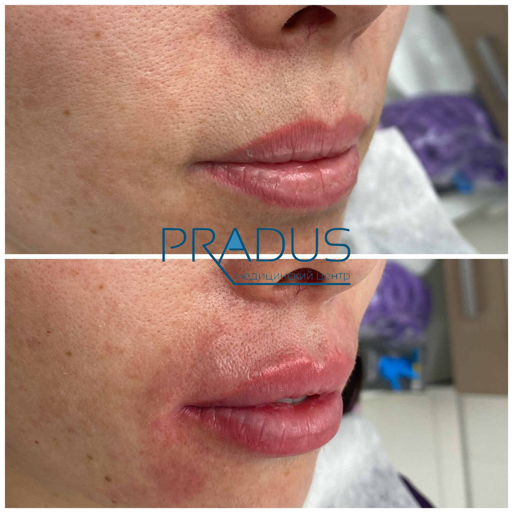 До и после контурной пластики губ. Увеличение объёма без утяжеления. PradusCOSMO, Васильевский остров