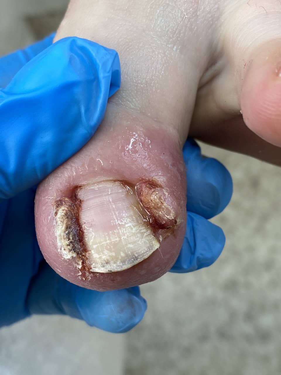 обработка вросшего ногтя