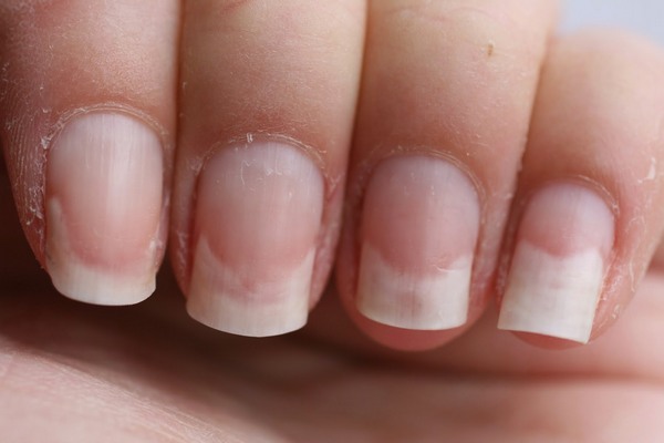 Наиболее часто встречающиеся болезни ногтей