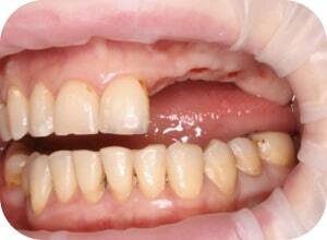 До имплантации