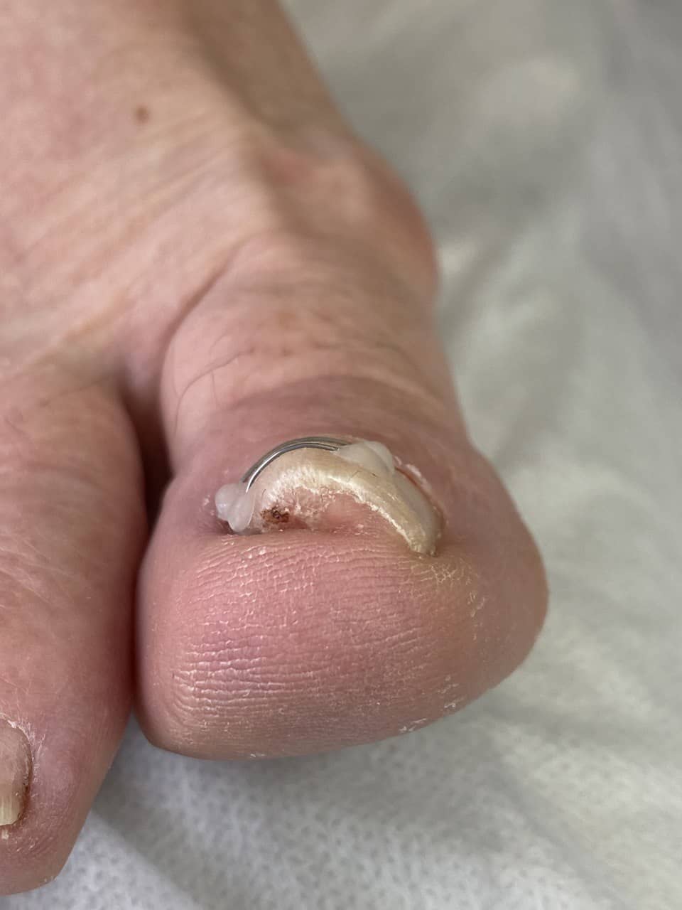 скобка +на ноготь