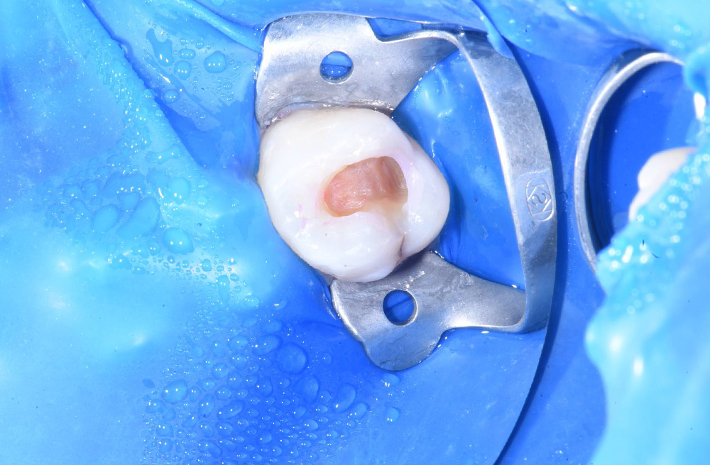 Замена некачественной пломбы и лечение глубокого кариеса перед ортодонтическим лечением