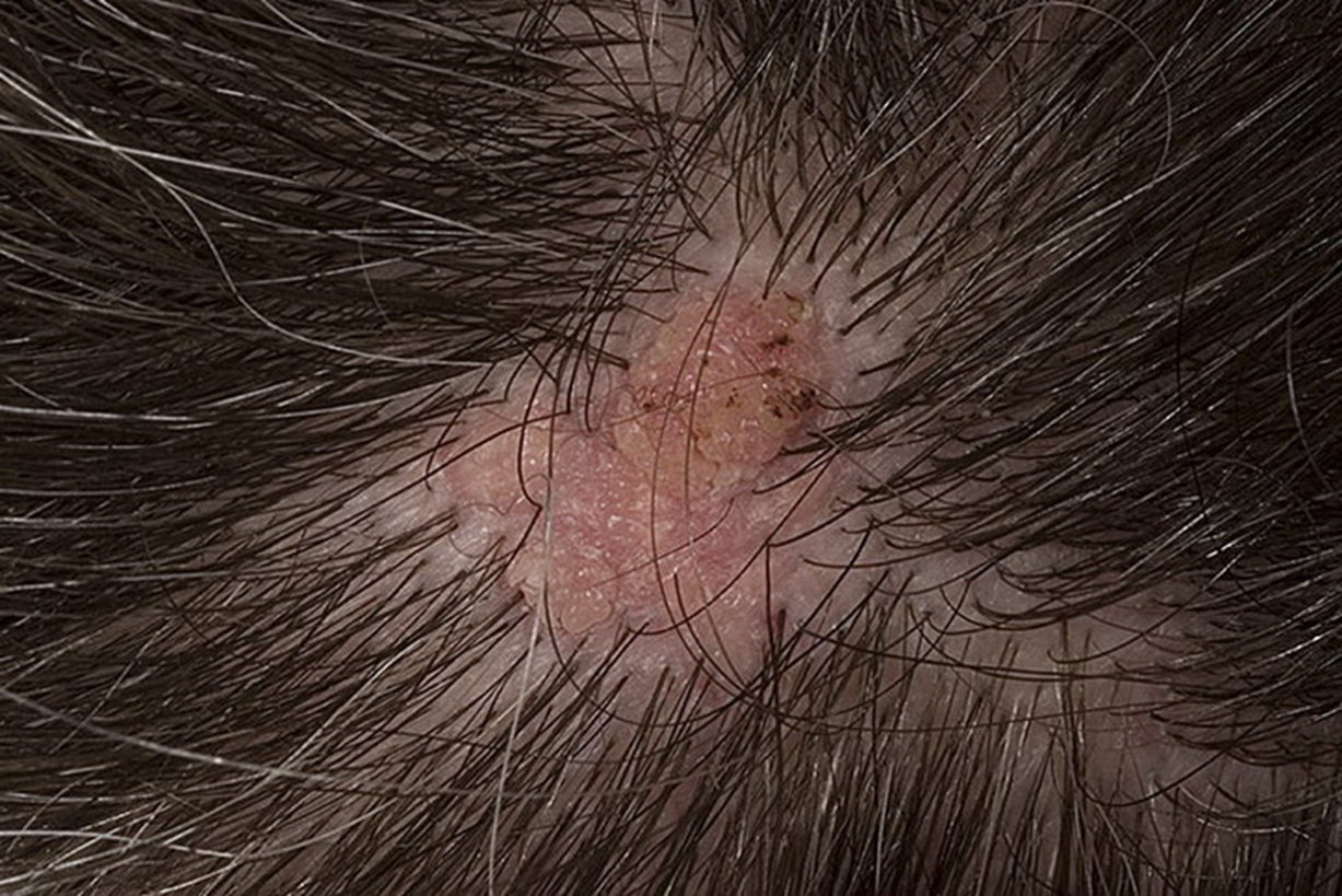 Грибок кожи головы симптомы и лечение