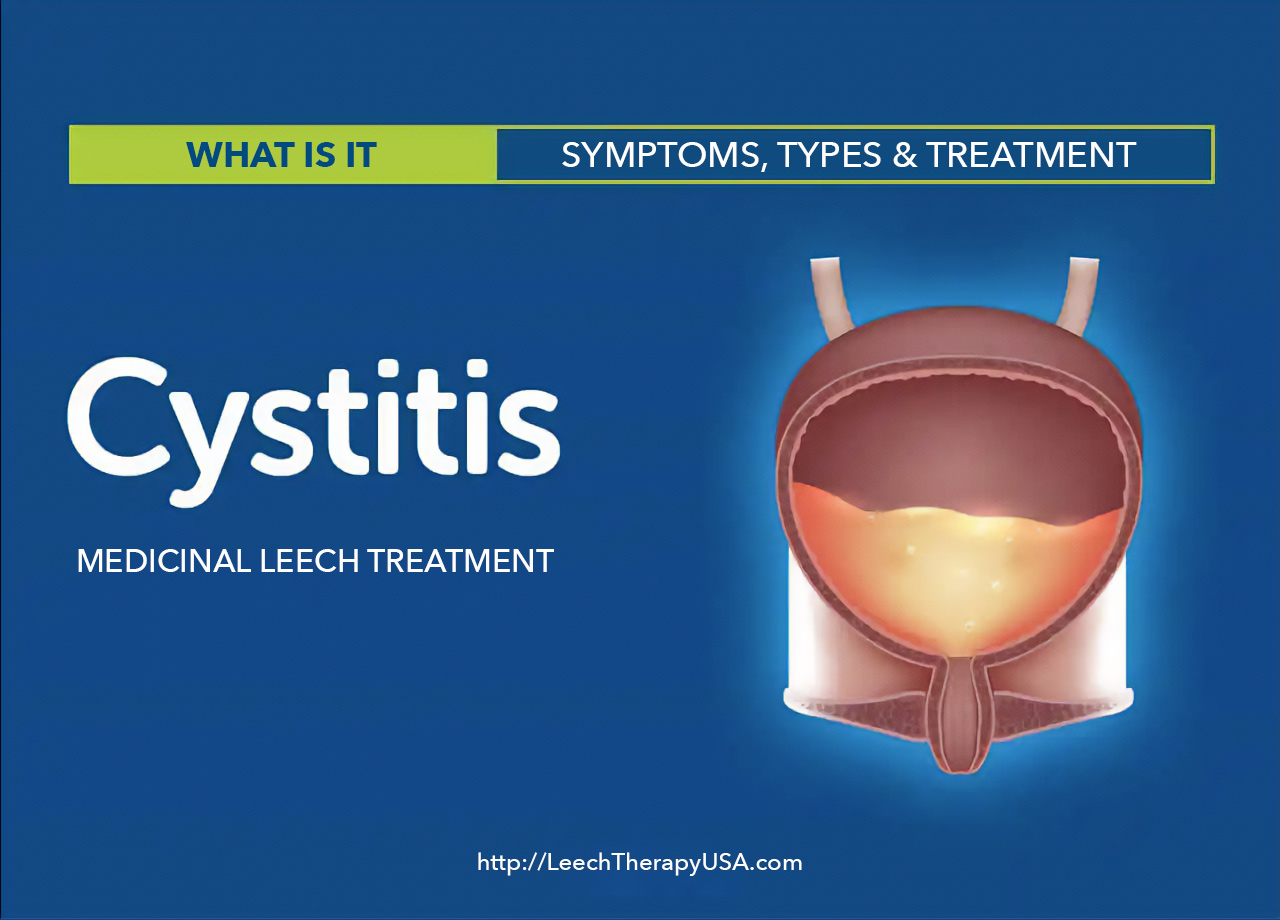 Cystitis treatment in Philadelphia, PA