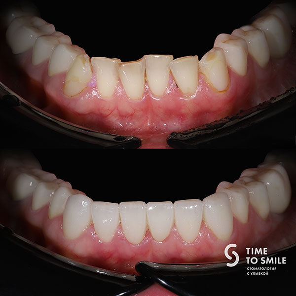 Виниры на зубы: фото до и после, разновидности