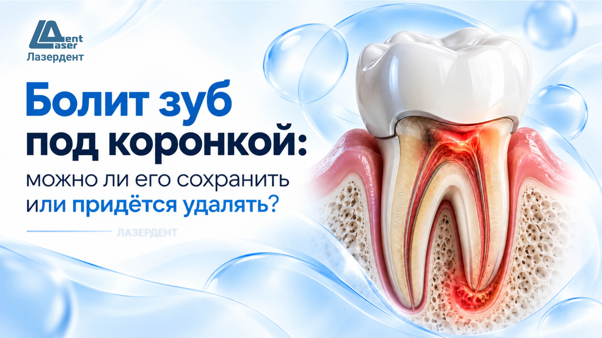 Болит зуб под коронкой — воспаление у корня зуба и боль при накусывании